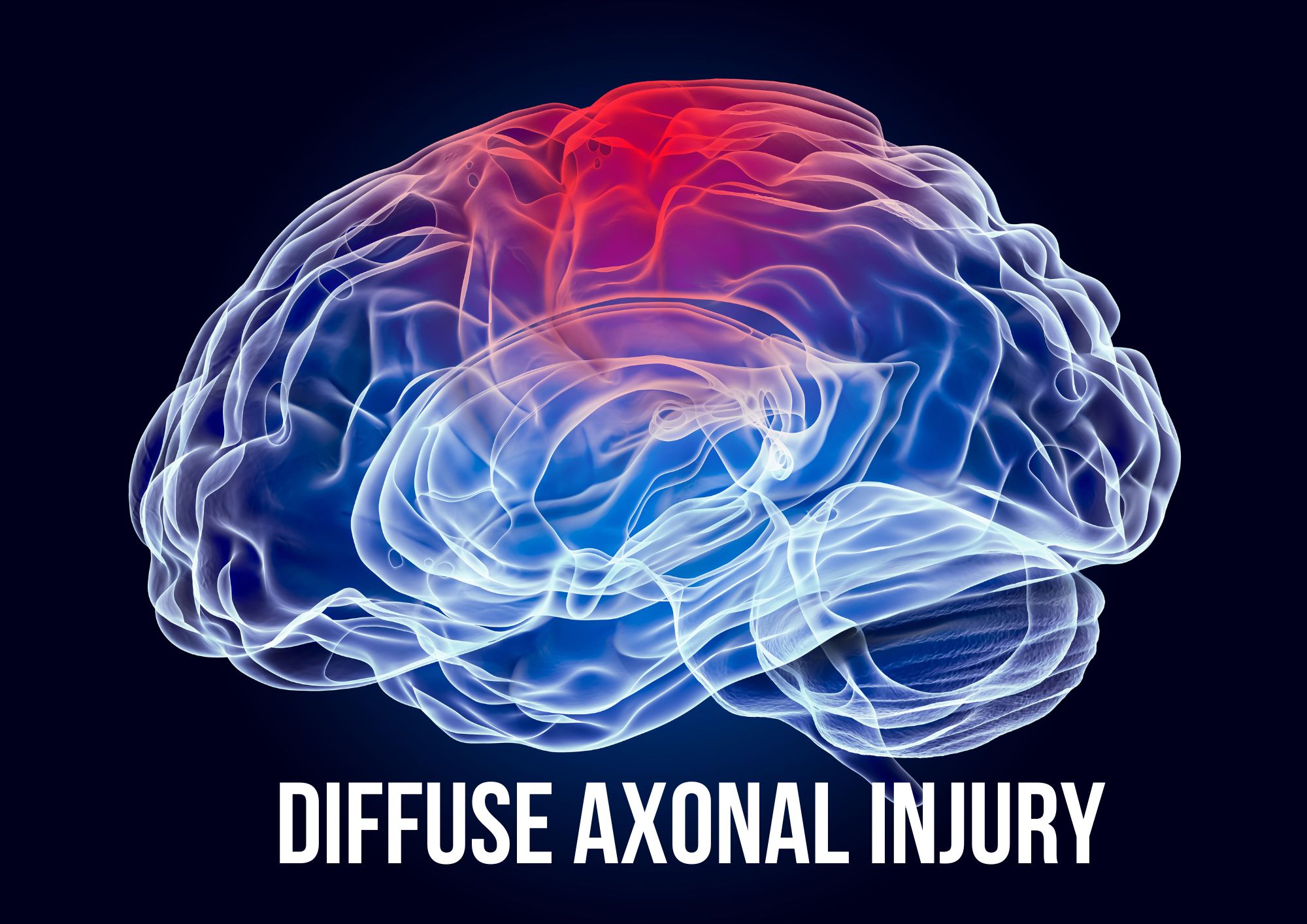 mengenal-diffuse-axonal-injury